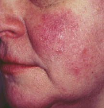 Rosacea