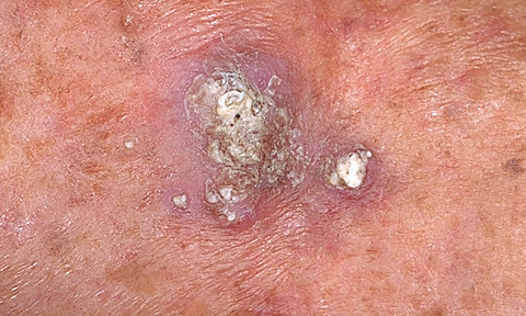 SQUAMOUS CELL CARCINOMA (SCC)