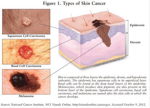 Skin Cancers