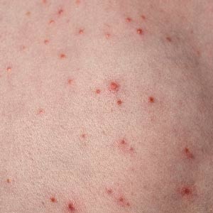 folliculitis