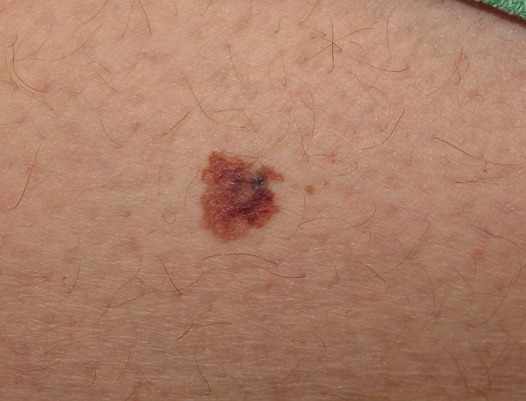 melanoma