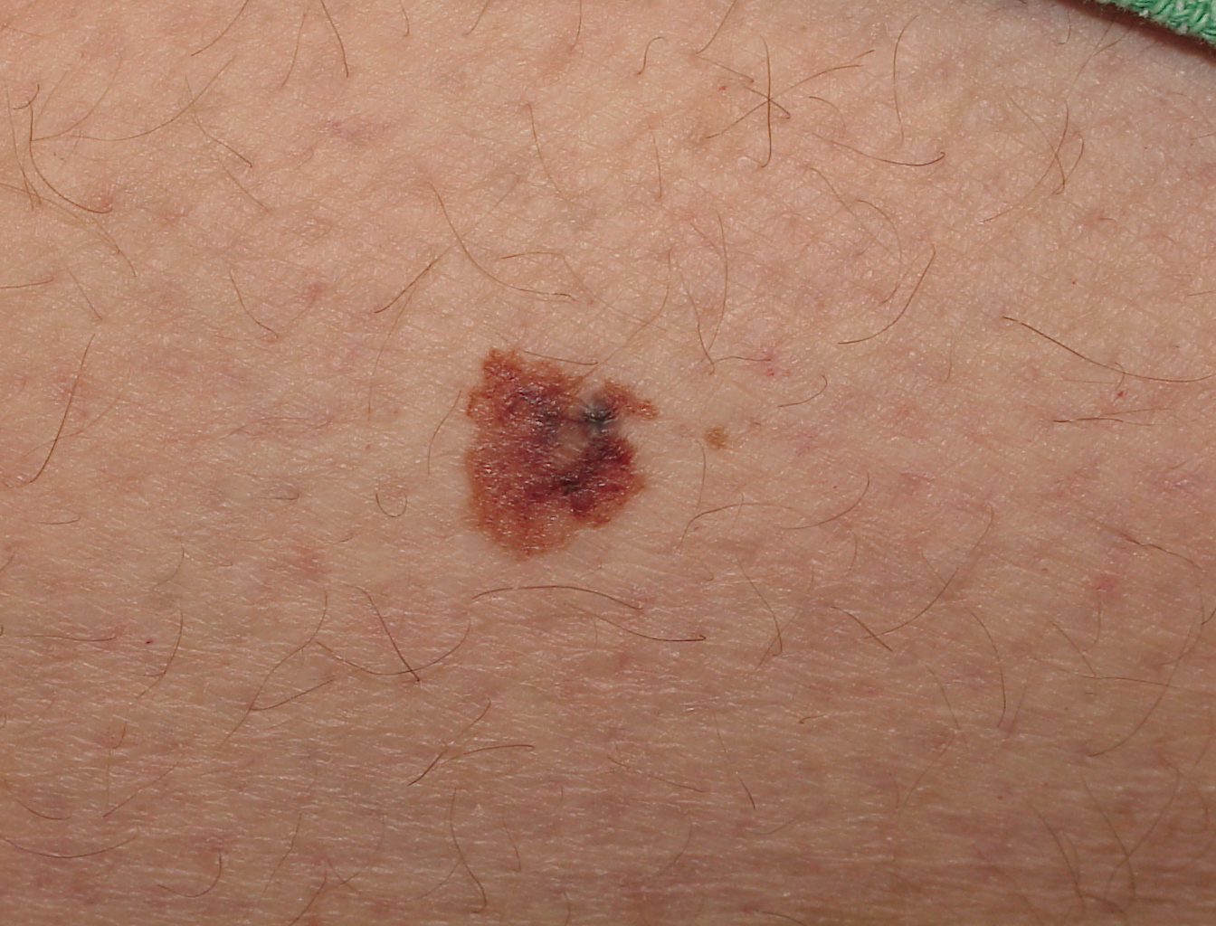 Melanoma: Cancer Treatment and Research main image 0